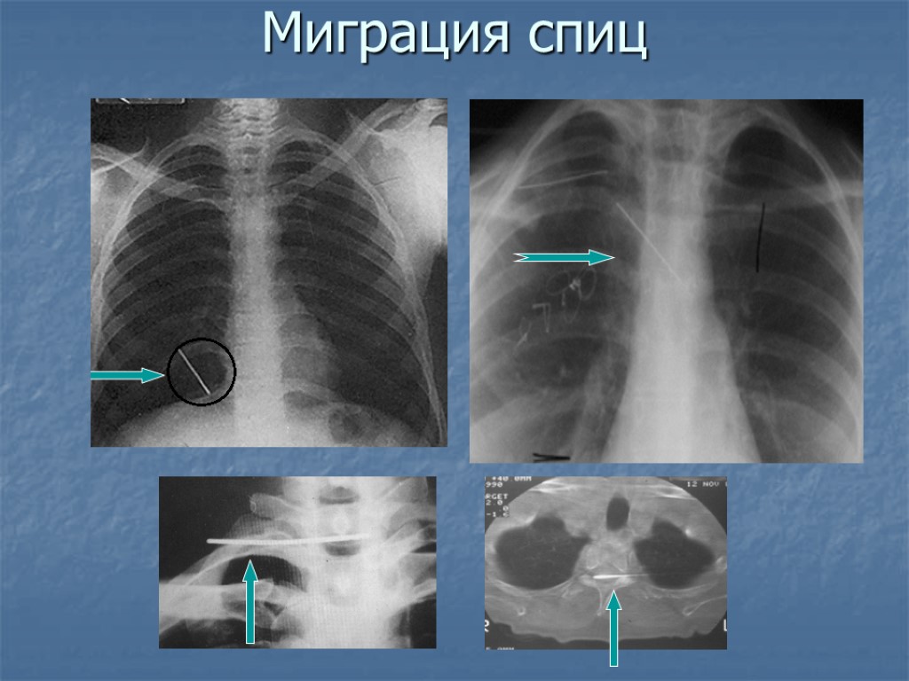 Миграция спиц